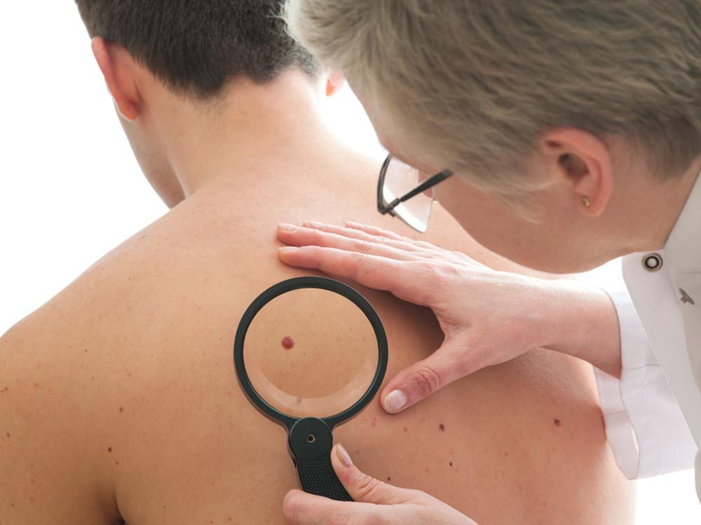 Mythes sur le cancer de la peau: seules les peaux claires courent un risque.