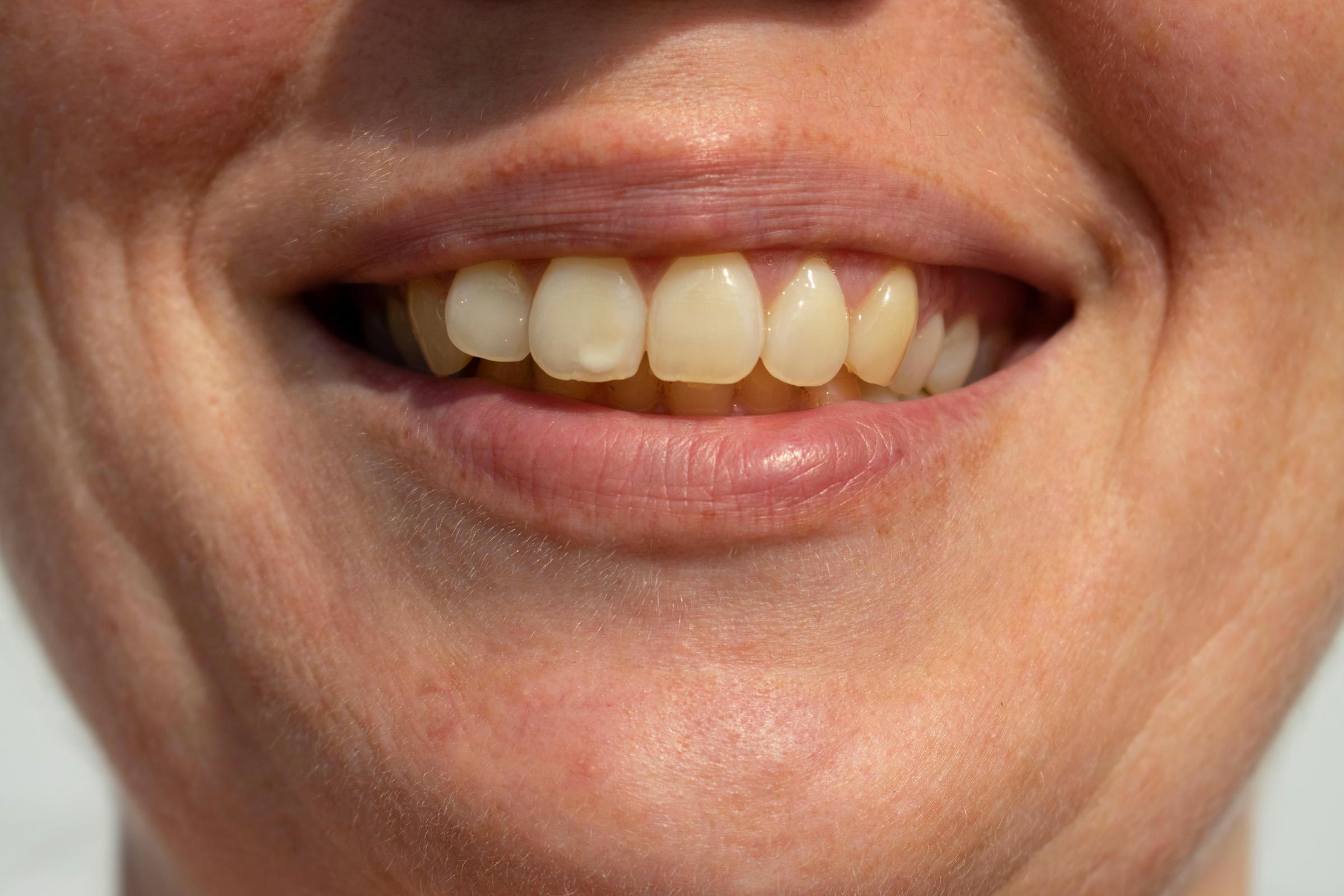 Signe inquiétant du corps : des taches sur les dents.